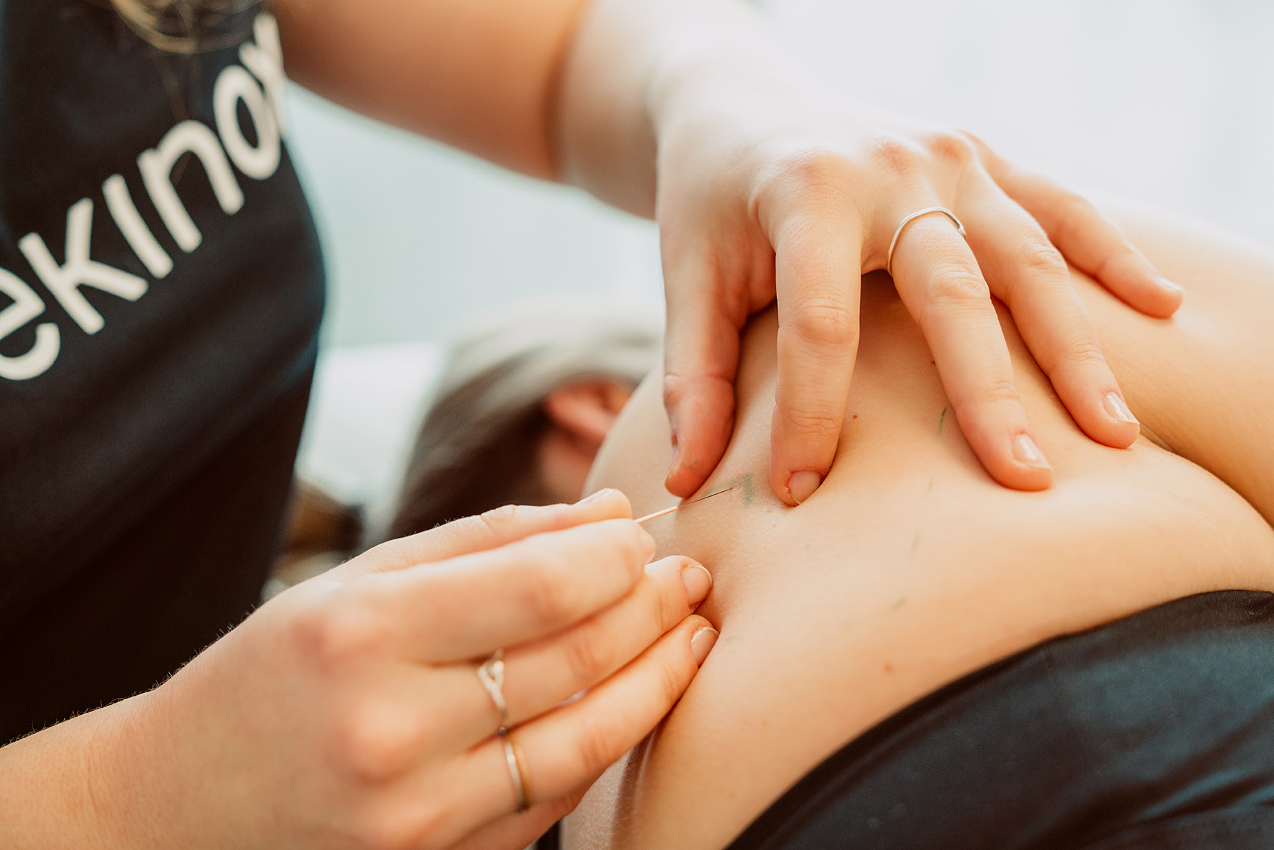 Aiguilles sèches en physiothérapie : les avantages
