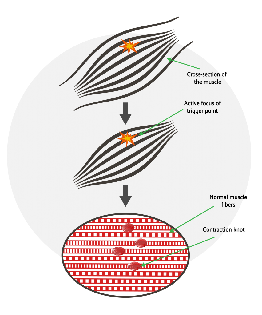 dry needling trigger point